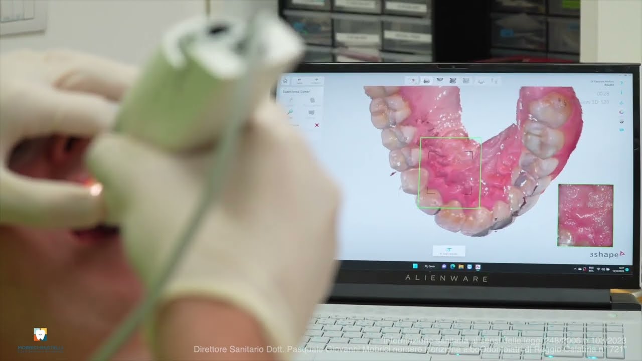 Scanner intraorale 3D: come funziona l'impronta dentale digitale