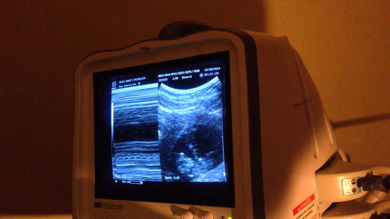 First Ultrasound - Dating Ultrasound | 10 Weeks Pregnant