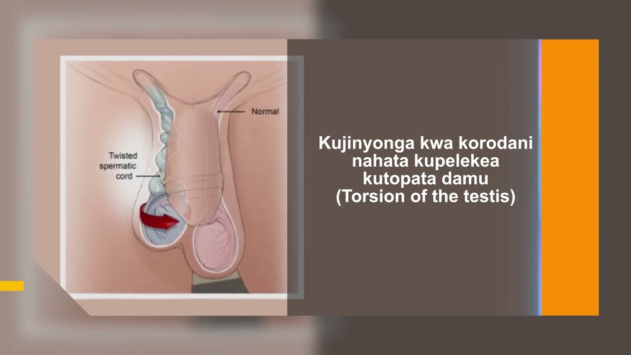 TATIZO LA UVIMBE KWENYE KORODANI