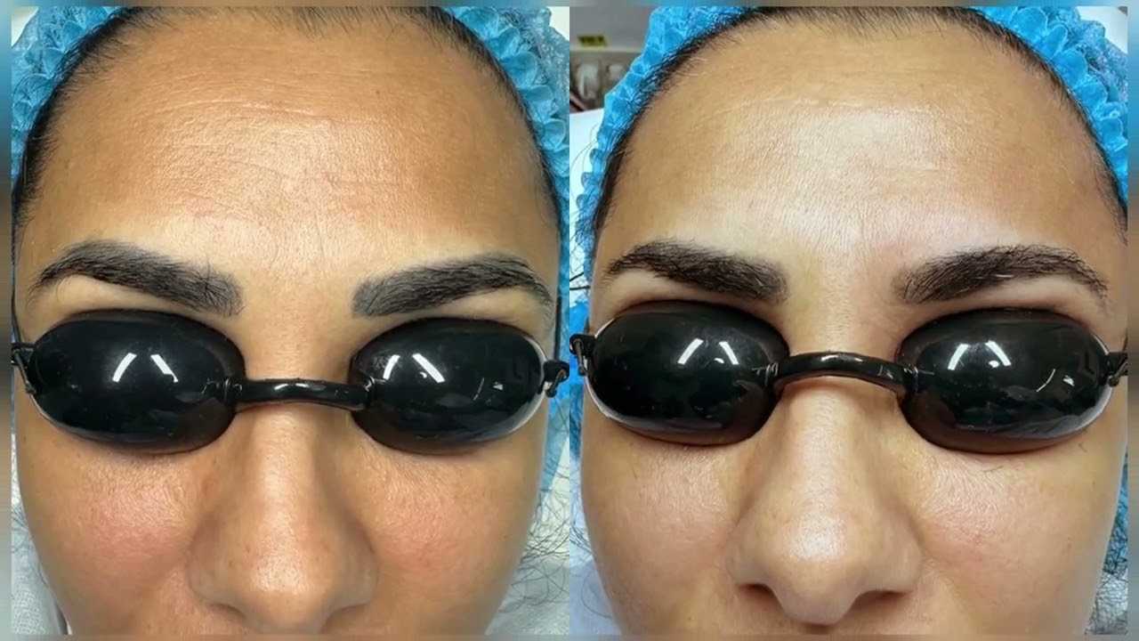LASER TATTOO REMOVAL si DERMOPIGMENTARE - ACEEASI SESIUNE