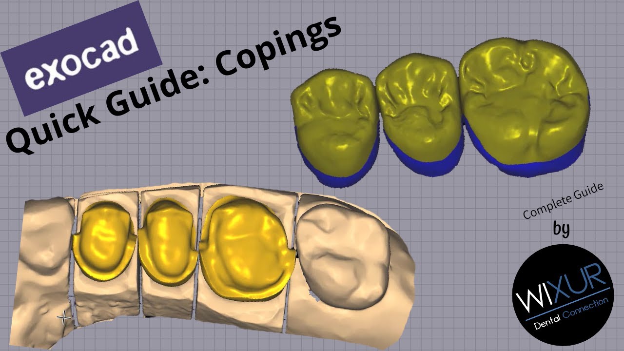 Exocad Quick Guide: Copings