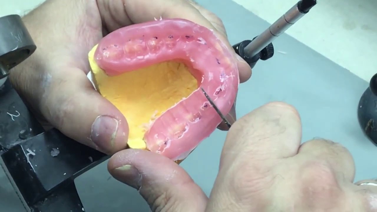 Construction of an Occlusal Bite Splint