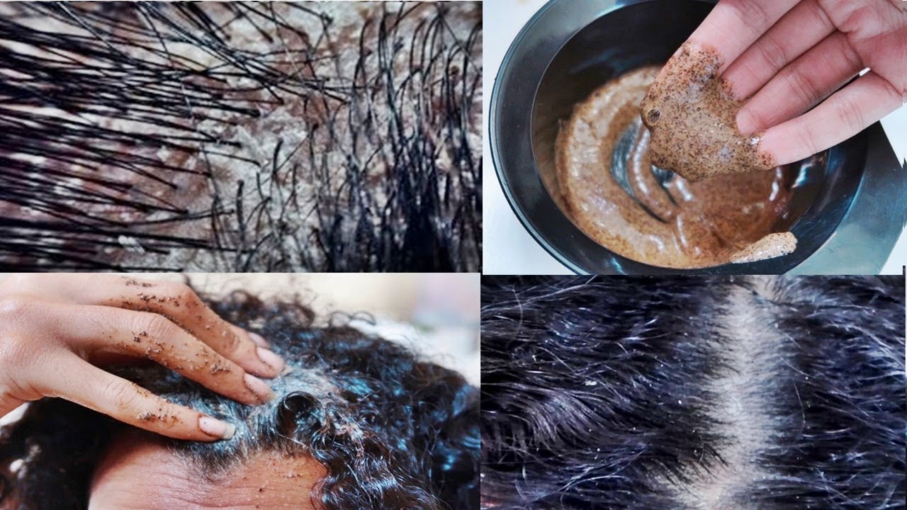 ACABEI COM A CASPA COM 2 INGREDIENTES NATURAIS