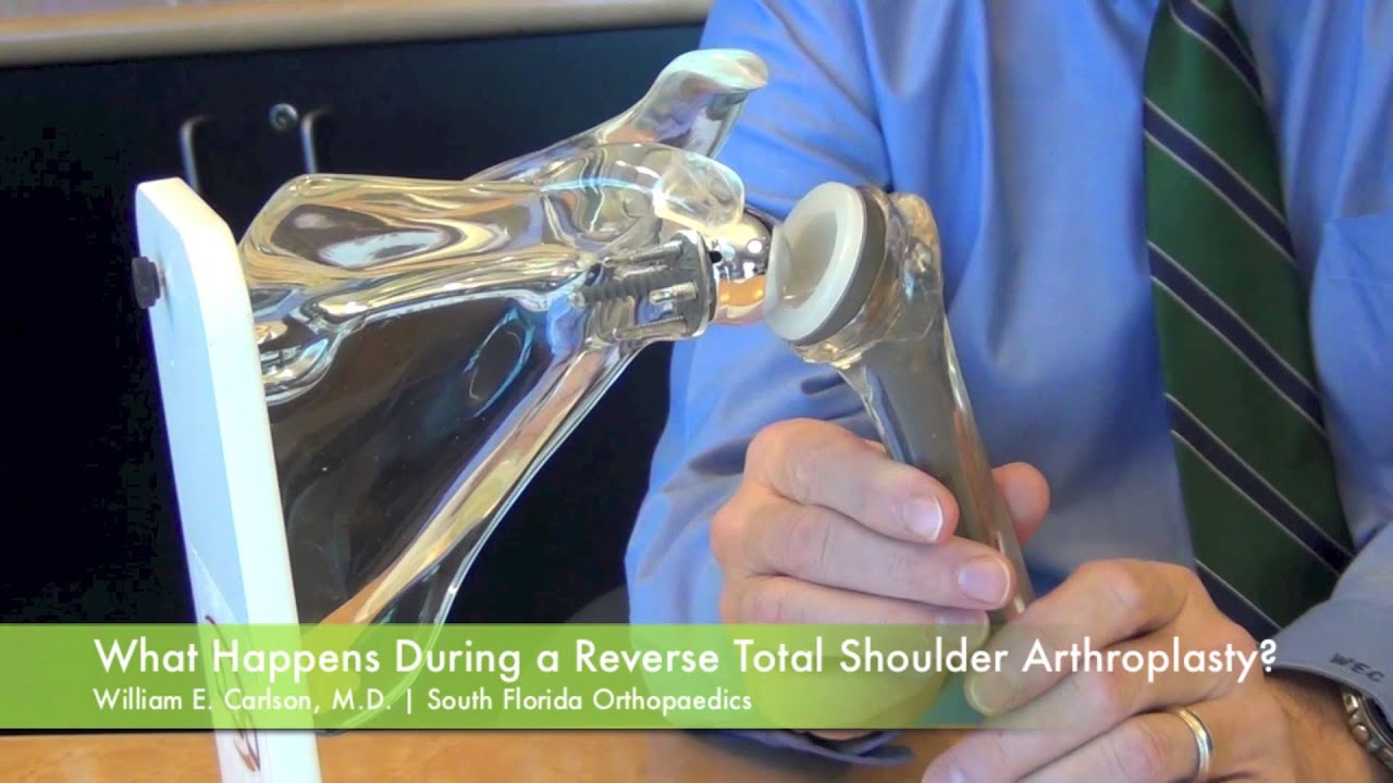 Reverse Total Shoulder Arthroplasty Surgery - Dr. William E. Carlson | South Florida Orthopaedics
