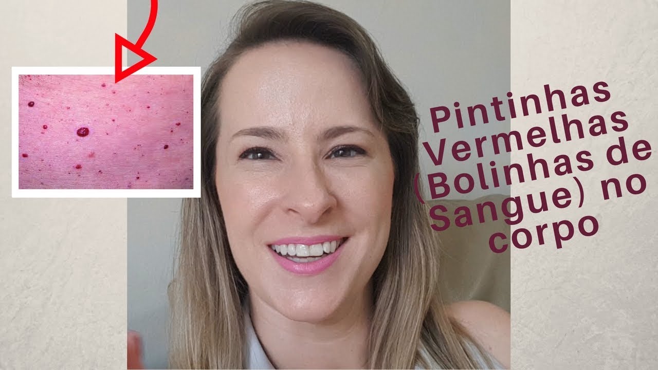 Pintinhas Vermelhas ou Bolinhas de Sangue no corpo - Dra Cínthia Orasmo