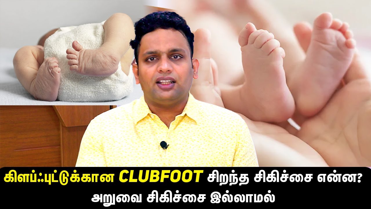 What Is The Best Treatment For Clubfoot?Without Surgery Dr Shriram Krishnamoorthy | Tamil