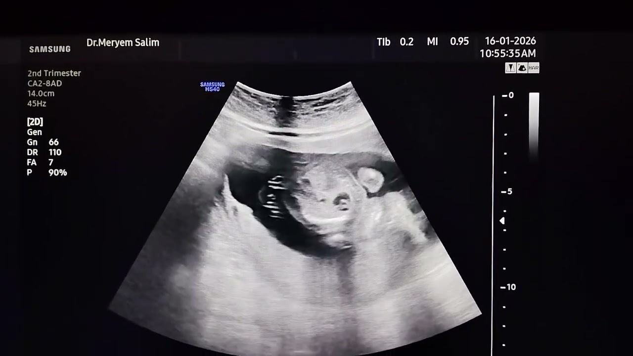  17w fetus  with cystic hygroma,with  (micromelia), and a small thoracic cage .. skeletal dysplasia