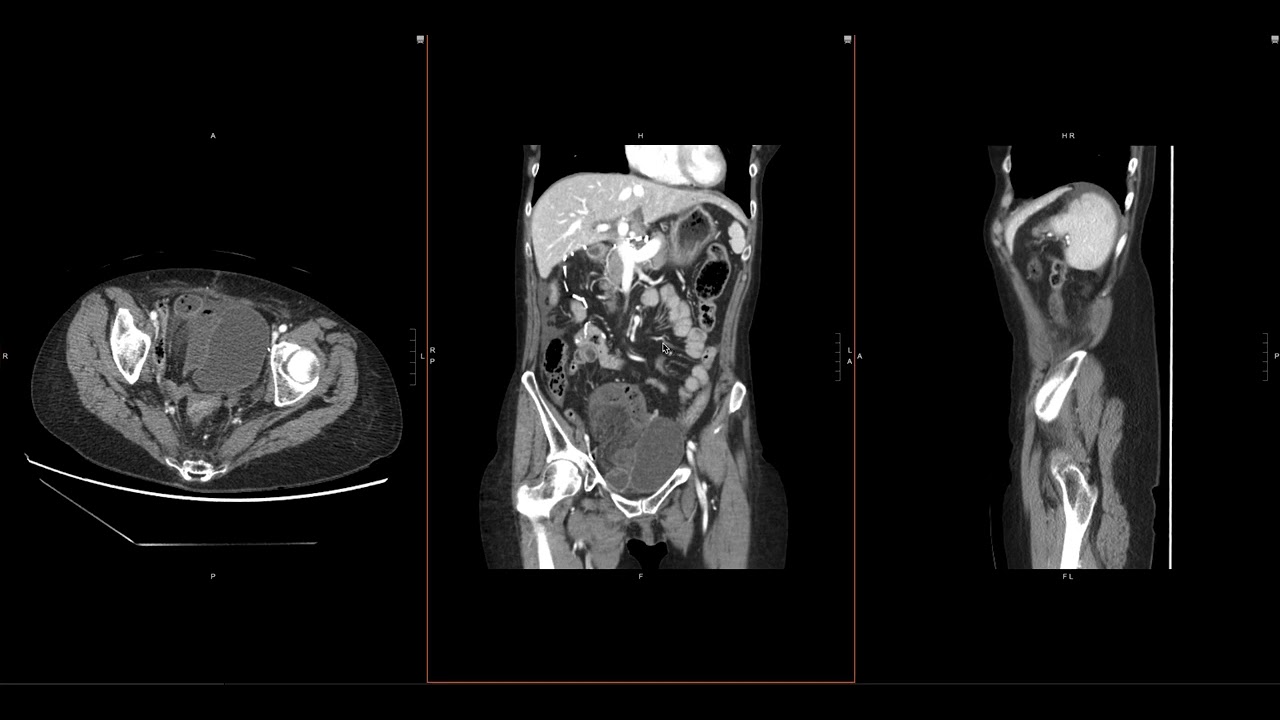 Abdominal Imaging Call Prep Cases: C​l​o​s​e​d​ ​L​o​o​p​ ​SBO​ ​(​C​T​) Search Pattern