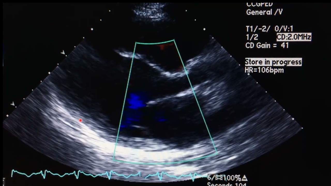 double pulse