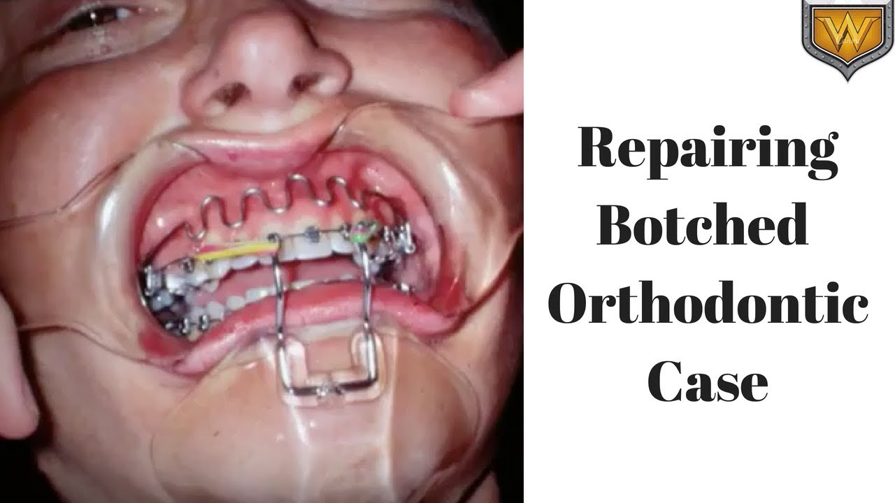 Repair of a Botched Orthodontic Case- using reverse headgear, upper lip bumper and opening space