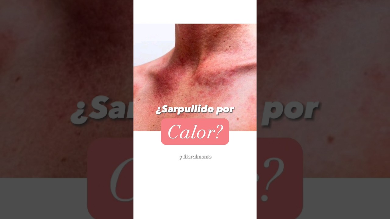 &iquest;Has tenido sarpullido por calor? #dermatologia #dermatologomonterrey #sarpullido #calor #onderm