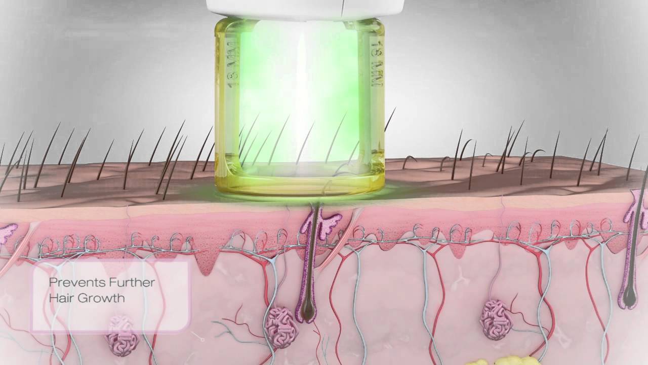 Candela Laser Hair Removal at Elysium Galway