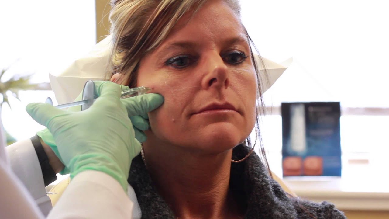 Juvederm Voluma XC Demonstration