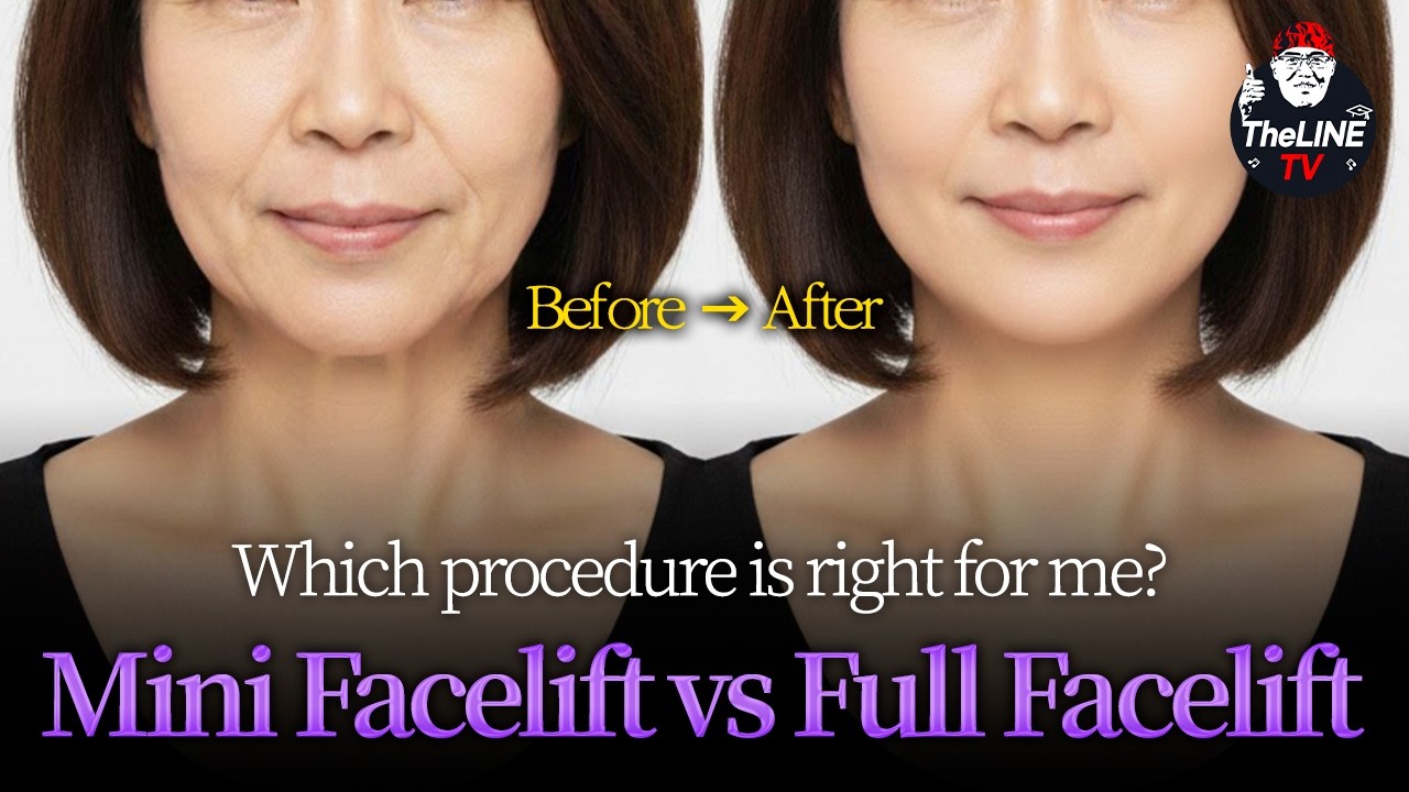 Surgeons explain the Mini Facelift for a youthful look #KBeauty #facelift #faceliftsurgery #theline