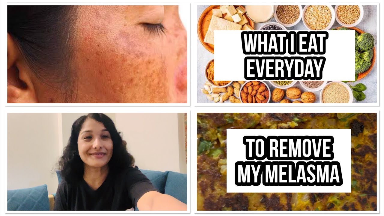 My diet for Melasma/ #melasma #pigmentation #lifestyle #dietformelasma 