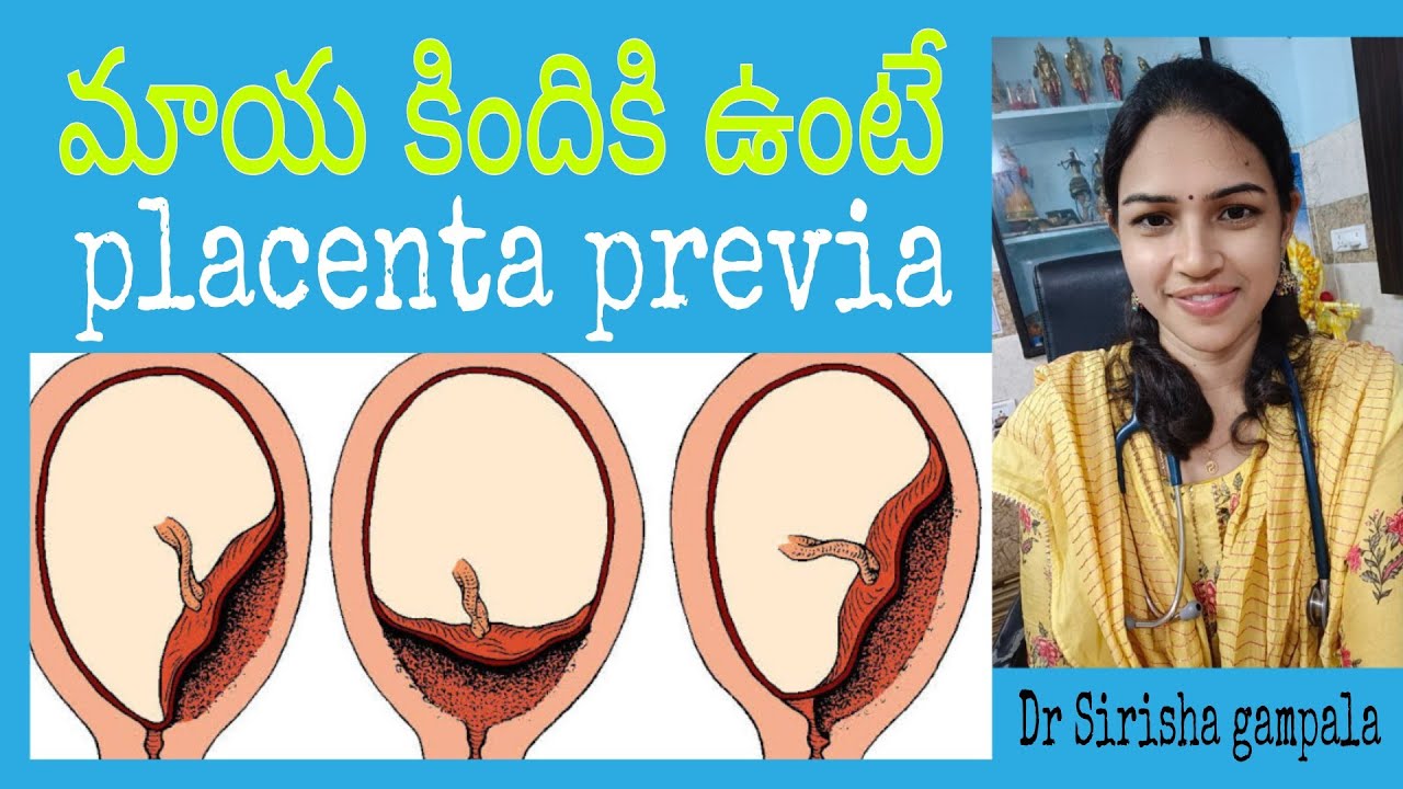 మాయ కిందికి ఉంటే || Placenta previa || low lying plcenta || health tips|| Dr sirisha gampala