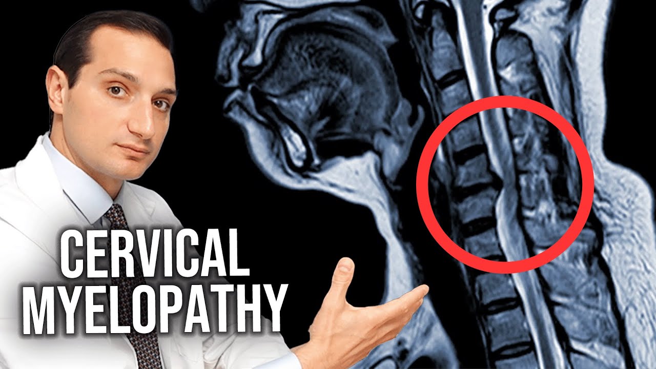 How Cervical Myelopathy Is Treated