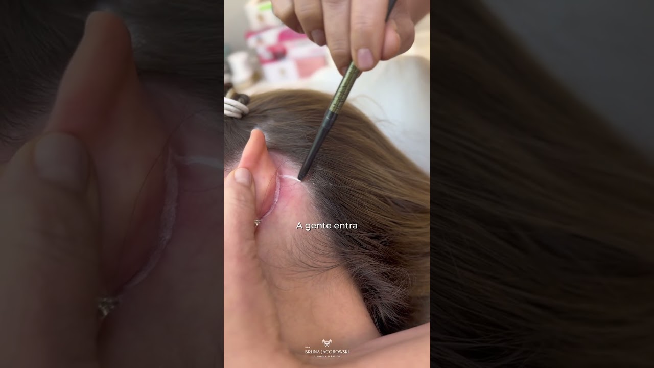 Cicatriz do lifting facial: ser&aacute; que fica aparente? Dra Bruna Jacobowski Cirurgi&atilde; Pl&aacute;stica Joinville