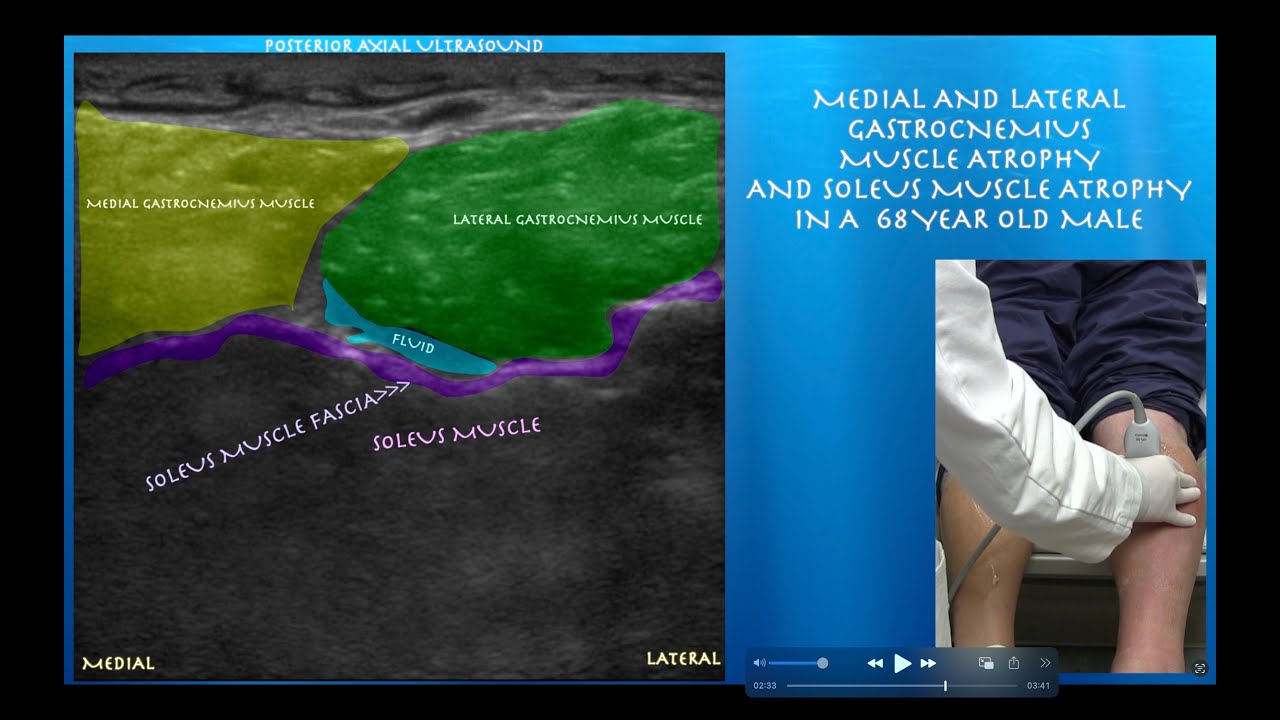 Ultrasound of Calf Atrophy by probeultrasound.com