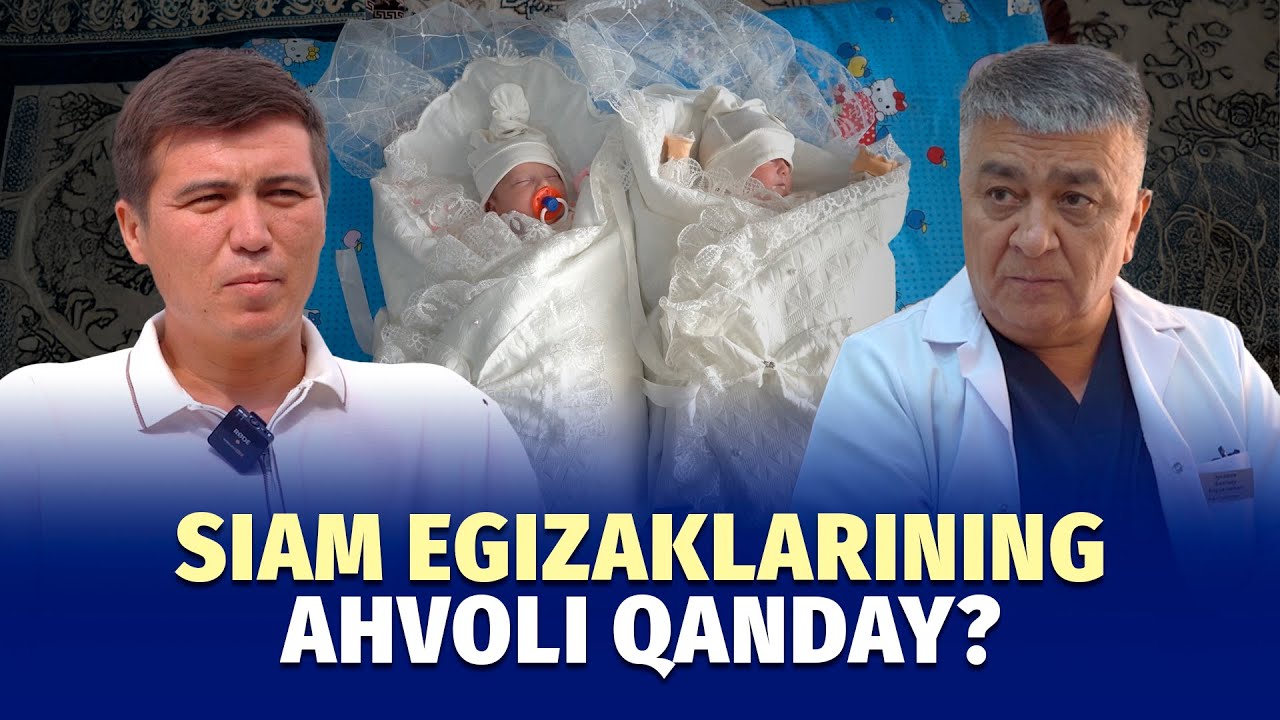 Chirchiqda tug‘ilgan siam egizaklari sog‘aymoqda