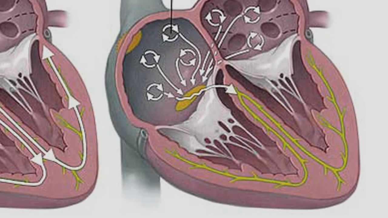 Förmaksflimmer och förebyggande Stroke behandling