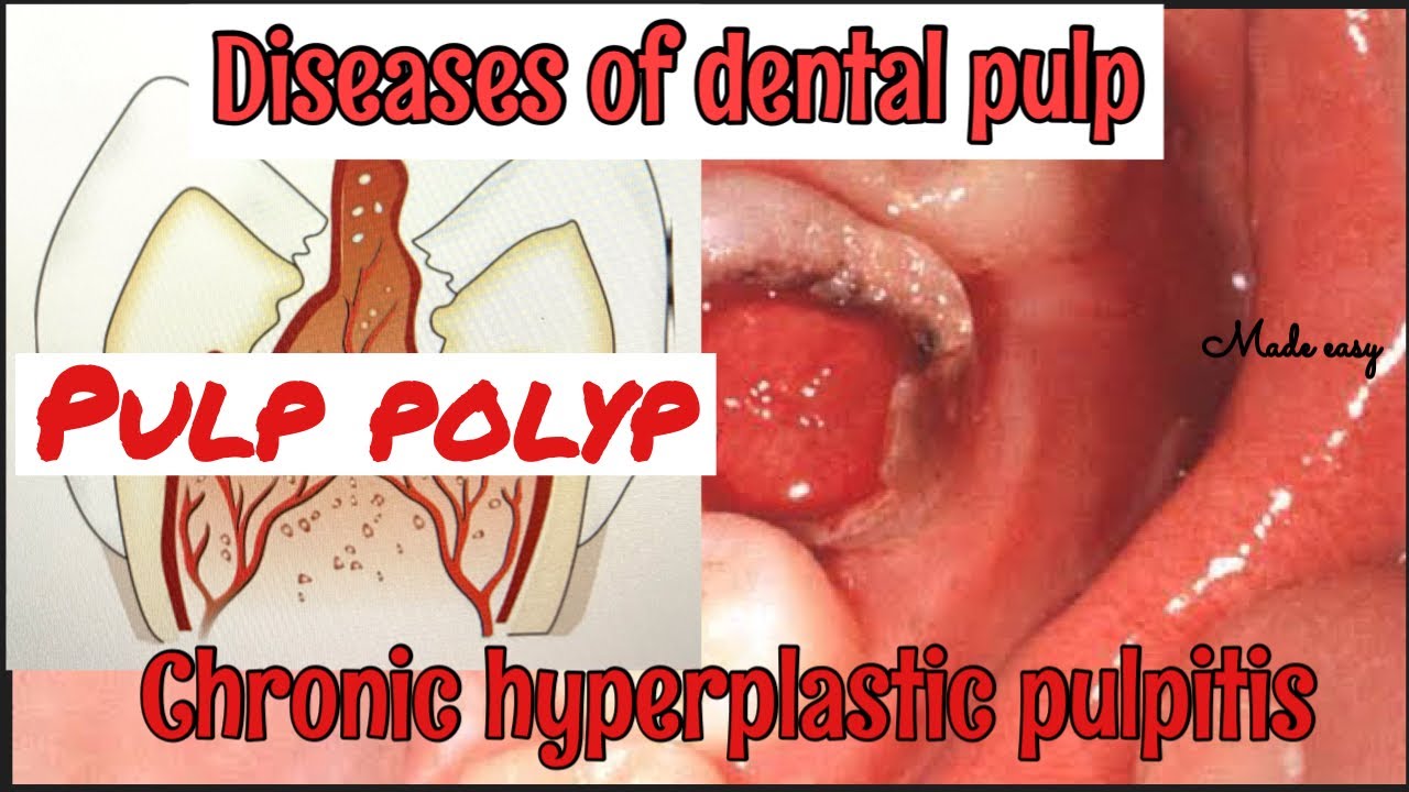 CHRONIC HYPERPLASTIC PULPITIS II PULP POLYP II DISEASES OF PULP II SERIES PART 4 II made easy