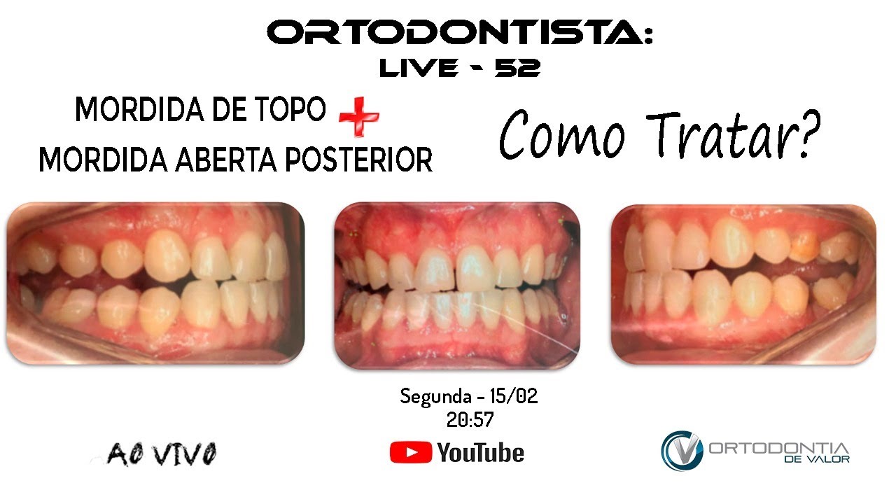 Live 52 -  Mordida de topo associada com mordida aberta posterior - Como TRATAR ?