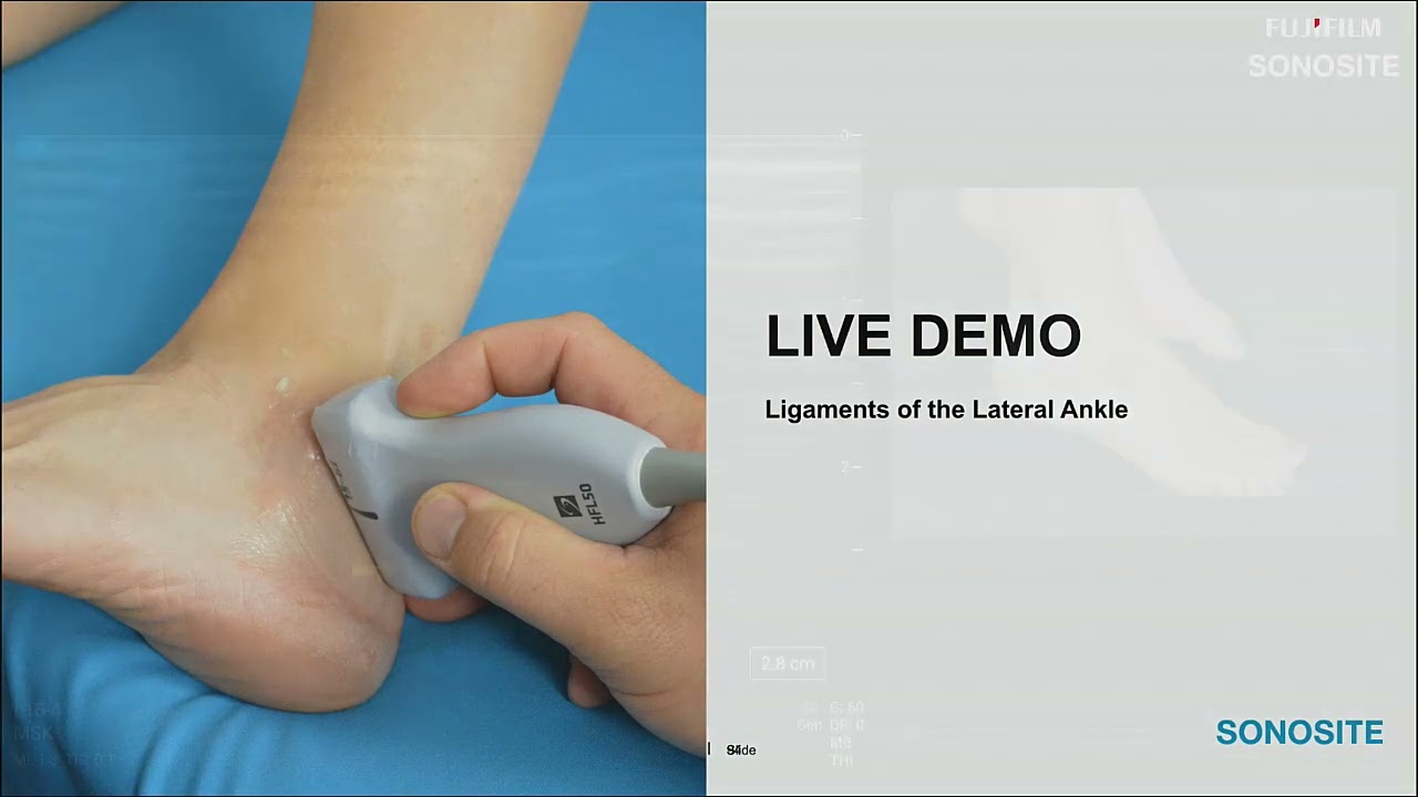 Webinar: Using Ultrasound to Evaluate the Lateral Ankle