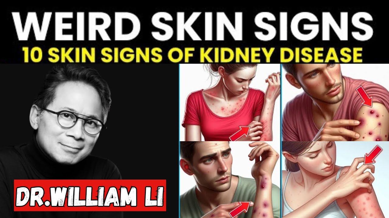 10 Silent Kidney Disease Signs on Your Skin You Shouldn't Ignore! Dr. William Li