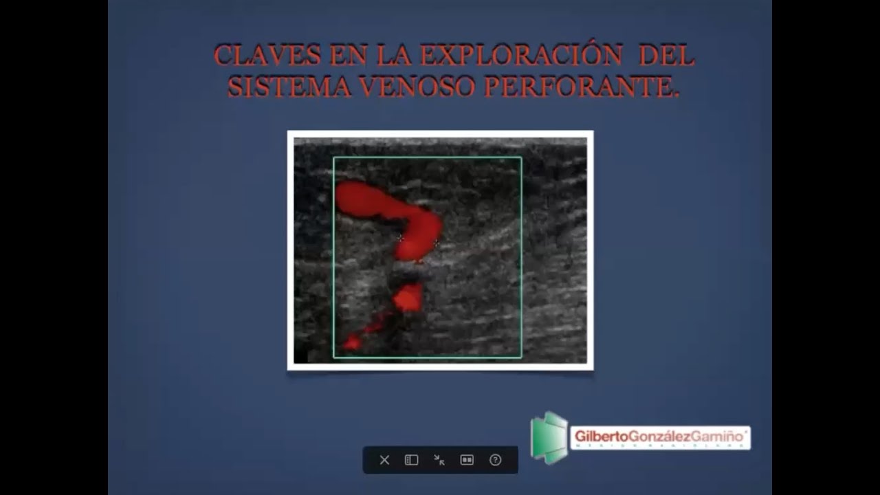 3 - 5 Claves en la exploración del sistema venoso perforante | Dr. González