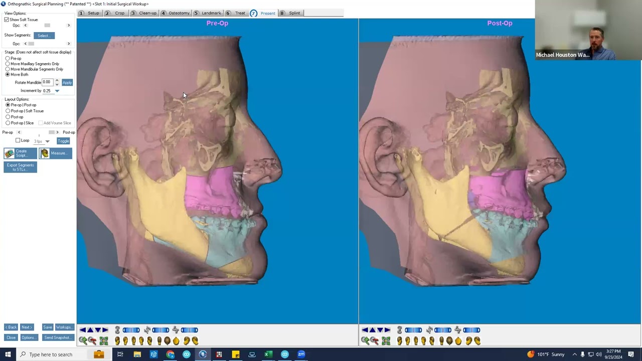 Lefort I osteotomy, Mandible vs. Maxilla First, Other Randomness.