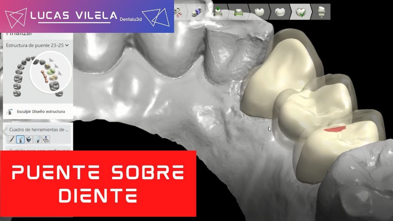 PUENTE SOBRE DIENTE / 3SHAPE