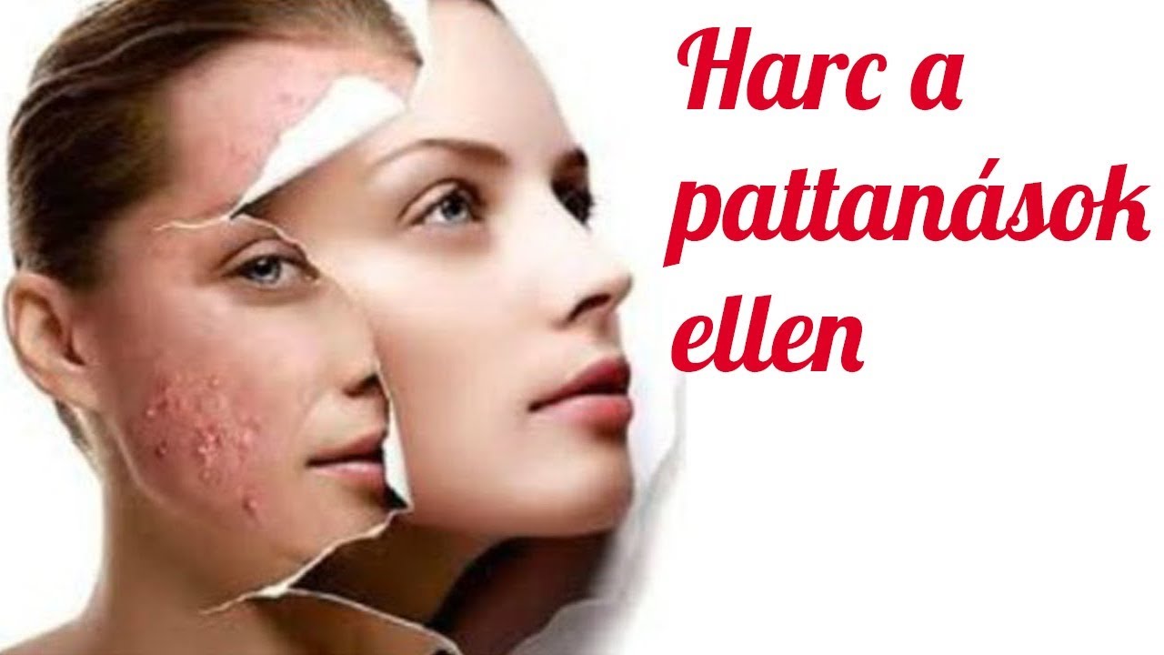 Pattan&aacute;s ellen | 10+1 tipp az akne megelőz&eacute;s&eacute;re | St&iacute;lus csevej Anettel