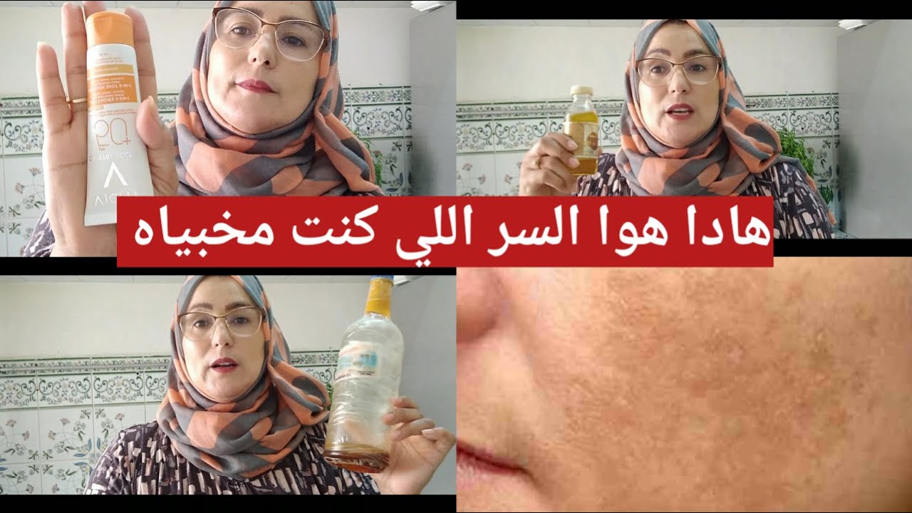 عانيت من الكلف مدة طويلة   وبهاد 2 مكونات ردولي ابتسامتي هاذا هوا السر اللي كنت مخبياه