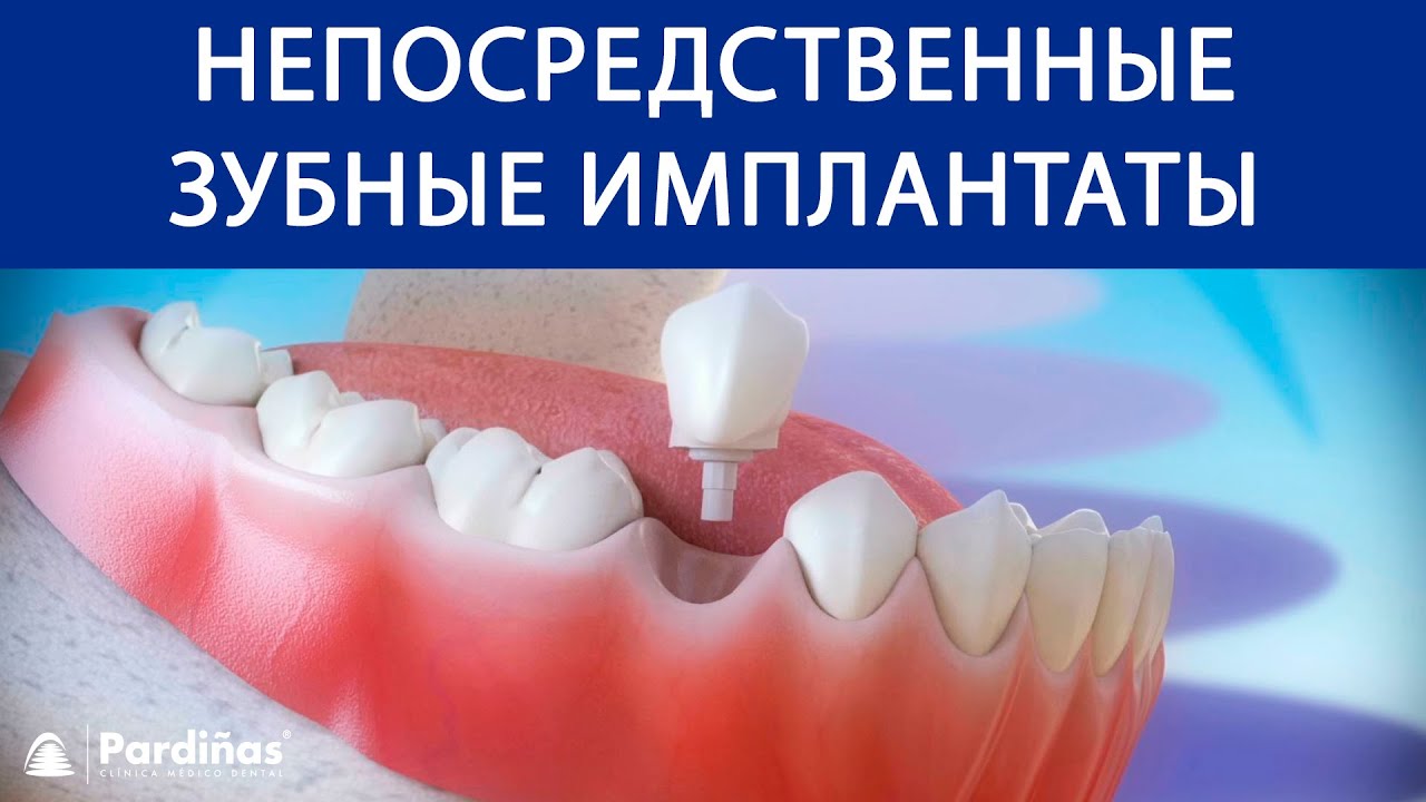 Непосредственные зубные имплантаты после удаление зуба &copy;