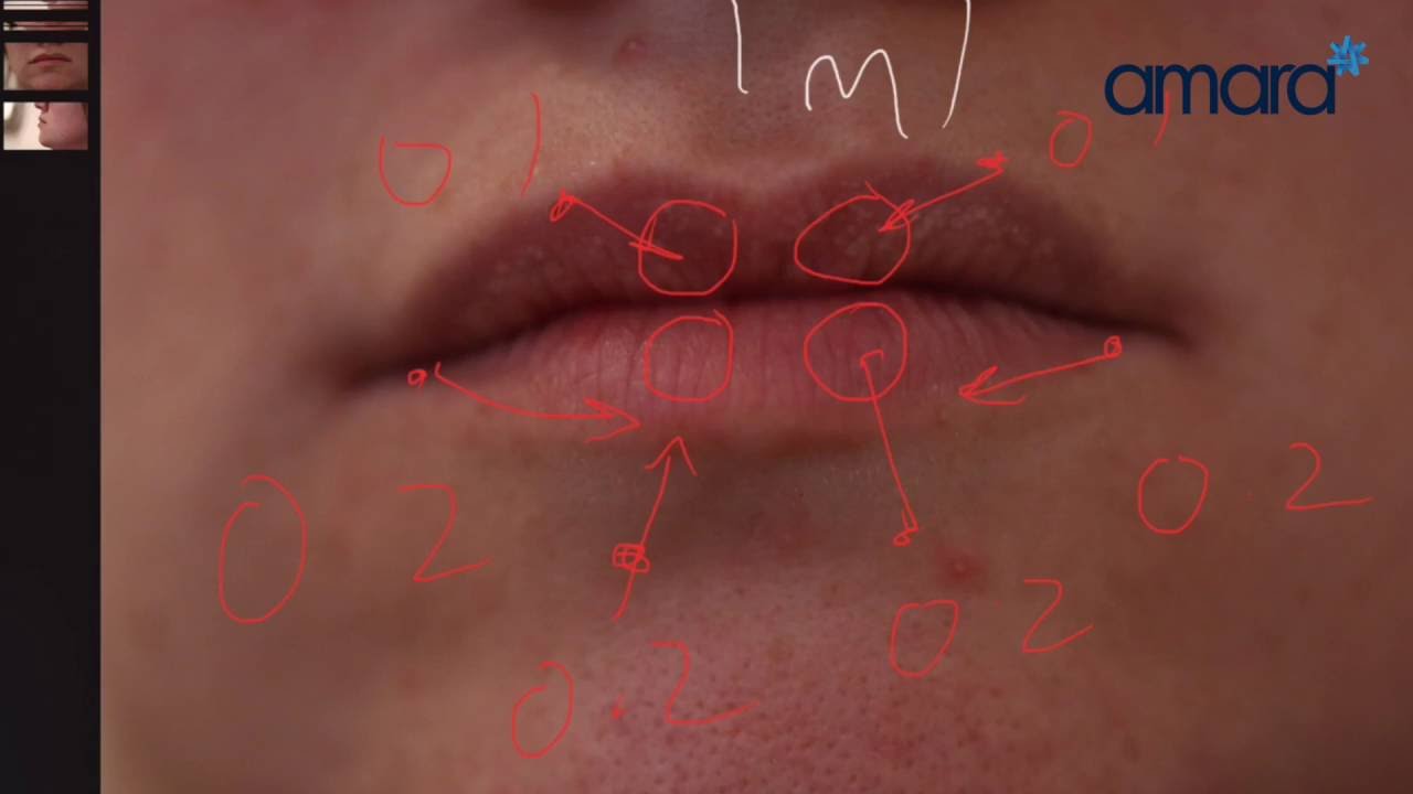 Lip Filler Before and After - The Perfect Lip For your Face
