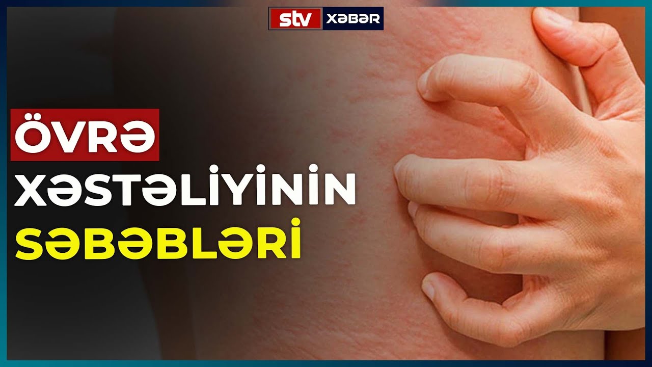 ÖVRƏ XƏSTƏLİYİNİN SƏBƏBLƏRİ - STV XƏBƏR