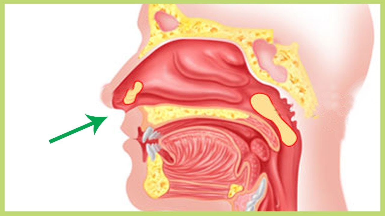 Waspada Terkena Sinusitis ! Begini Cara Mengobati Sinusitis Akut !