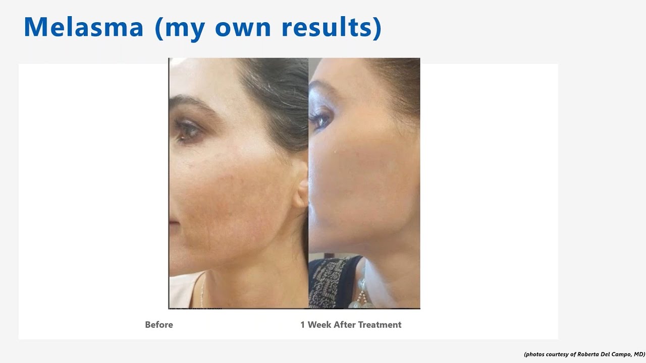 Webinar: Hyperpigmentation & Rejuvenation