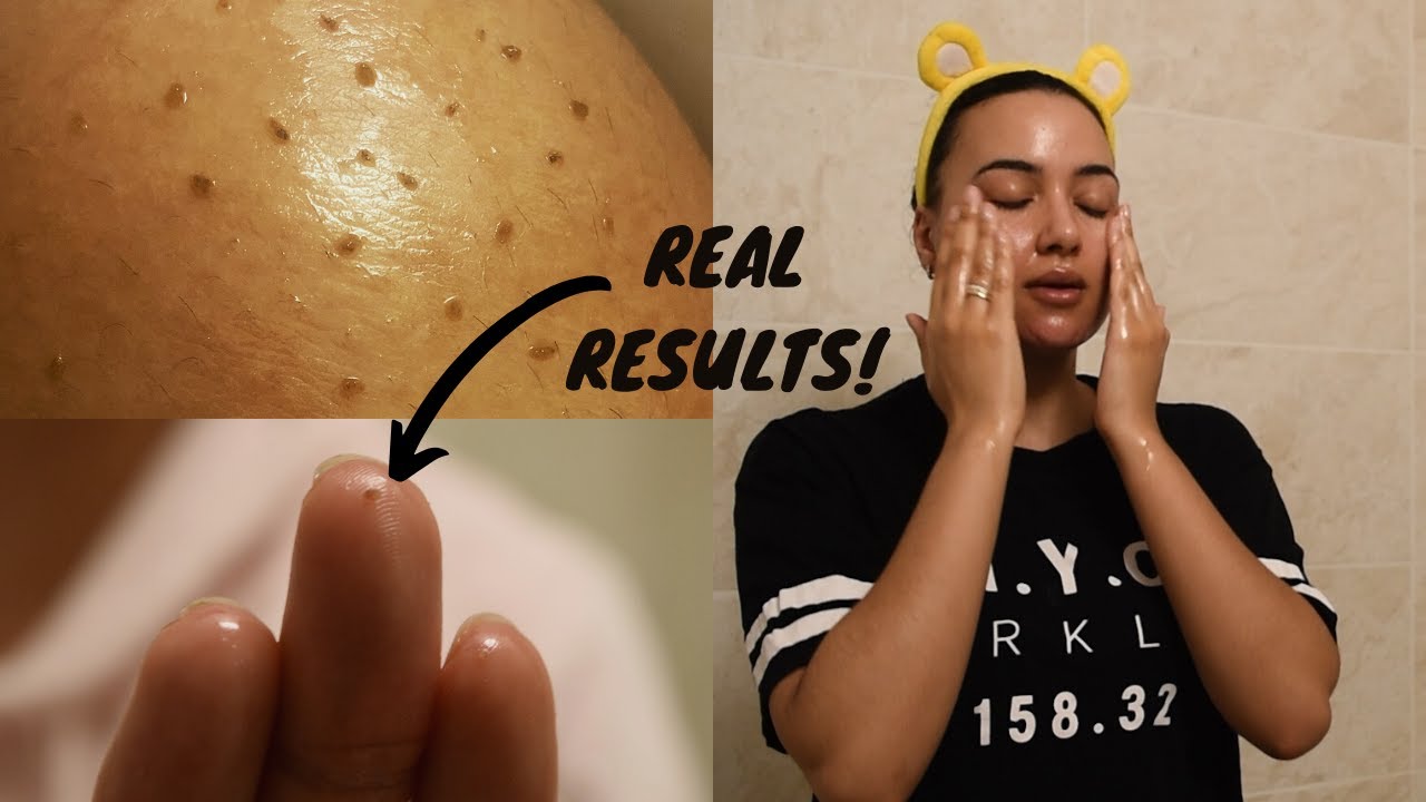 REMOVING SEBACEOUS FILAMENTS |OIL CLEANSING WITH OLIVE OIL | Oil plugs, blackheads & ACTUAL RESULTS!