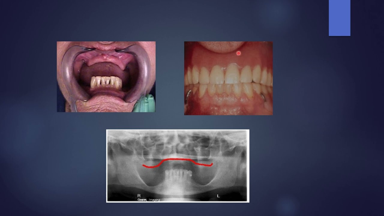 Management of compromised ridges in prosthodontics