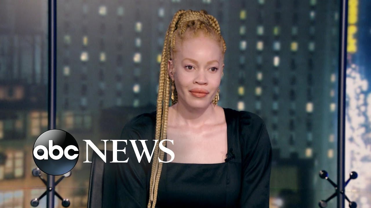 'War of Colors' documents fighting discrimination against albinism | ABCNL