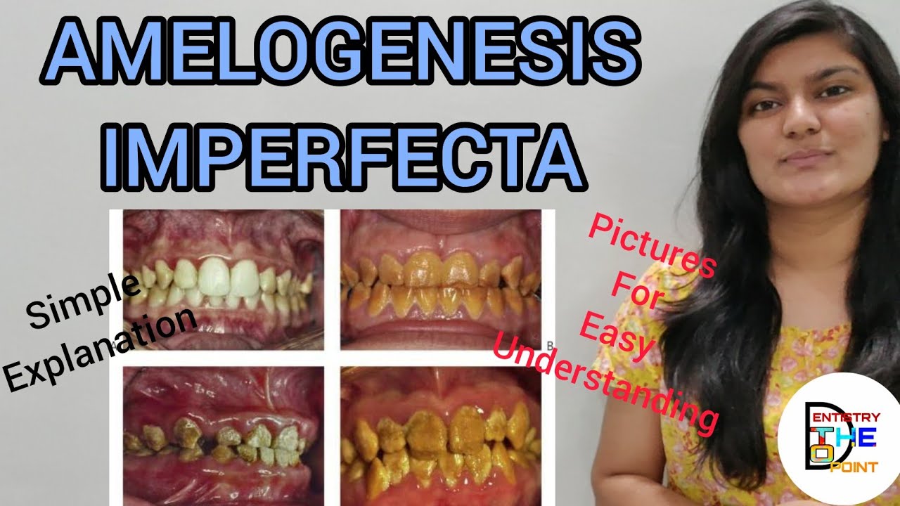 AMELOGENESIS IMPERFECTA - DEVELOPMENTAL DISTURBANCES IN STRUCTURE OF TEETH