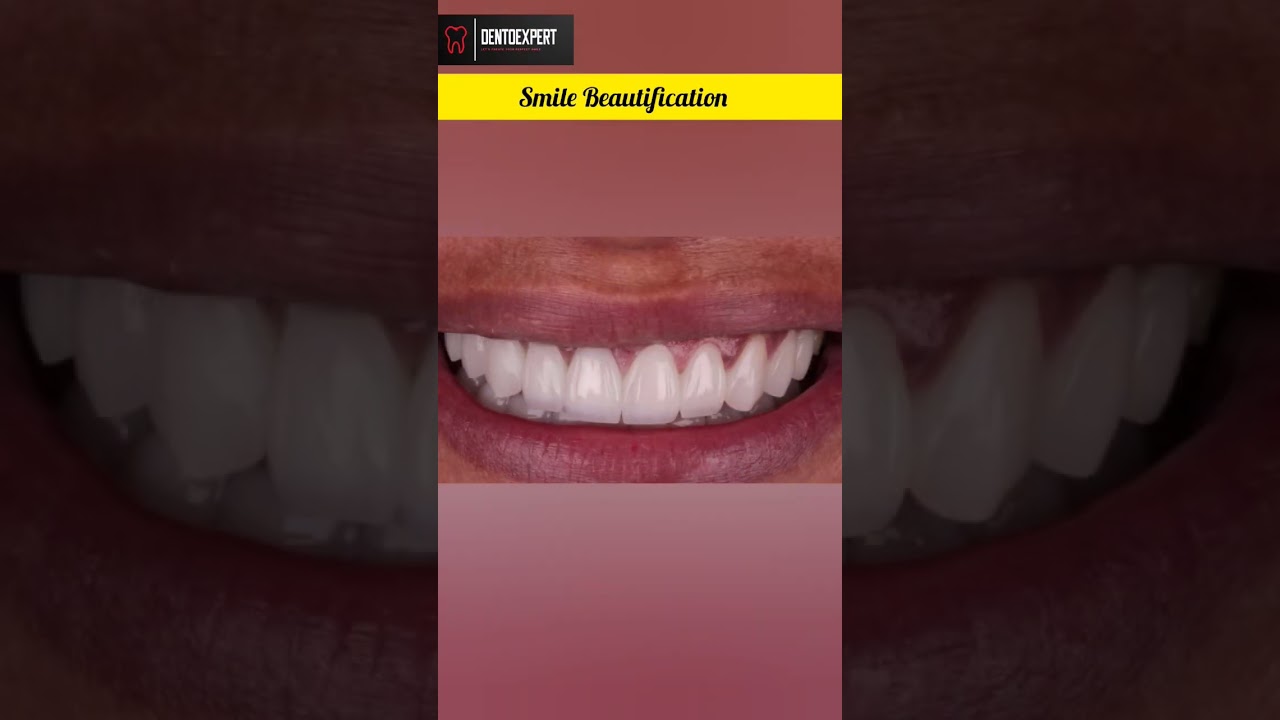 Microdontia + Yellow Stained Teeth + Gummy Smile + Tilted Incisor Treatment #shorts #dentist #viral
