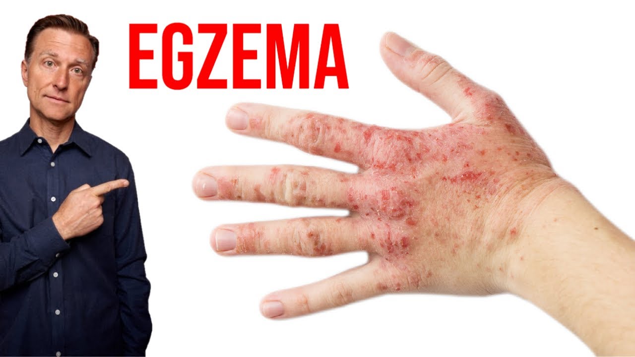 Egzama Salisilat Alerjisinden mi Geliyor? - Atopik Dermatit | Dr.Berg Türkçe