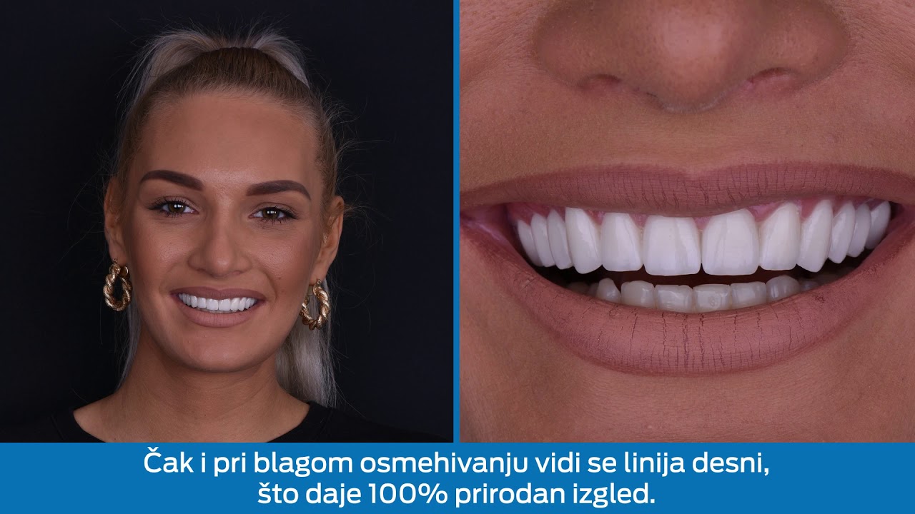 Hollywood smile u punom sjaju