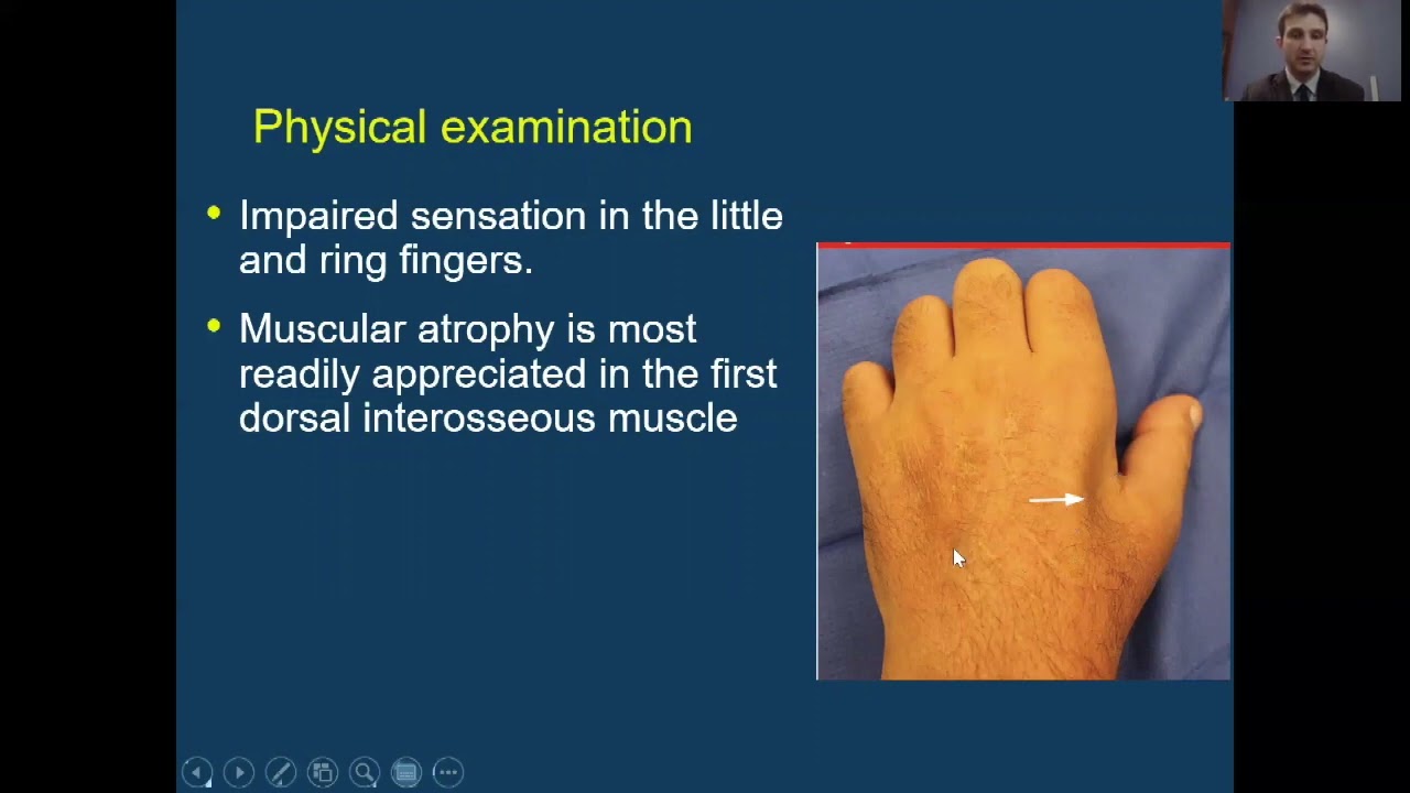 UOI Community Lecture Series  - Cubital Tunnel Syndrome Explained