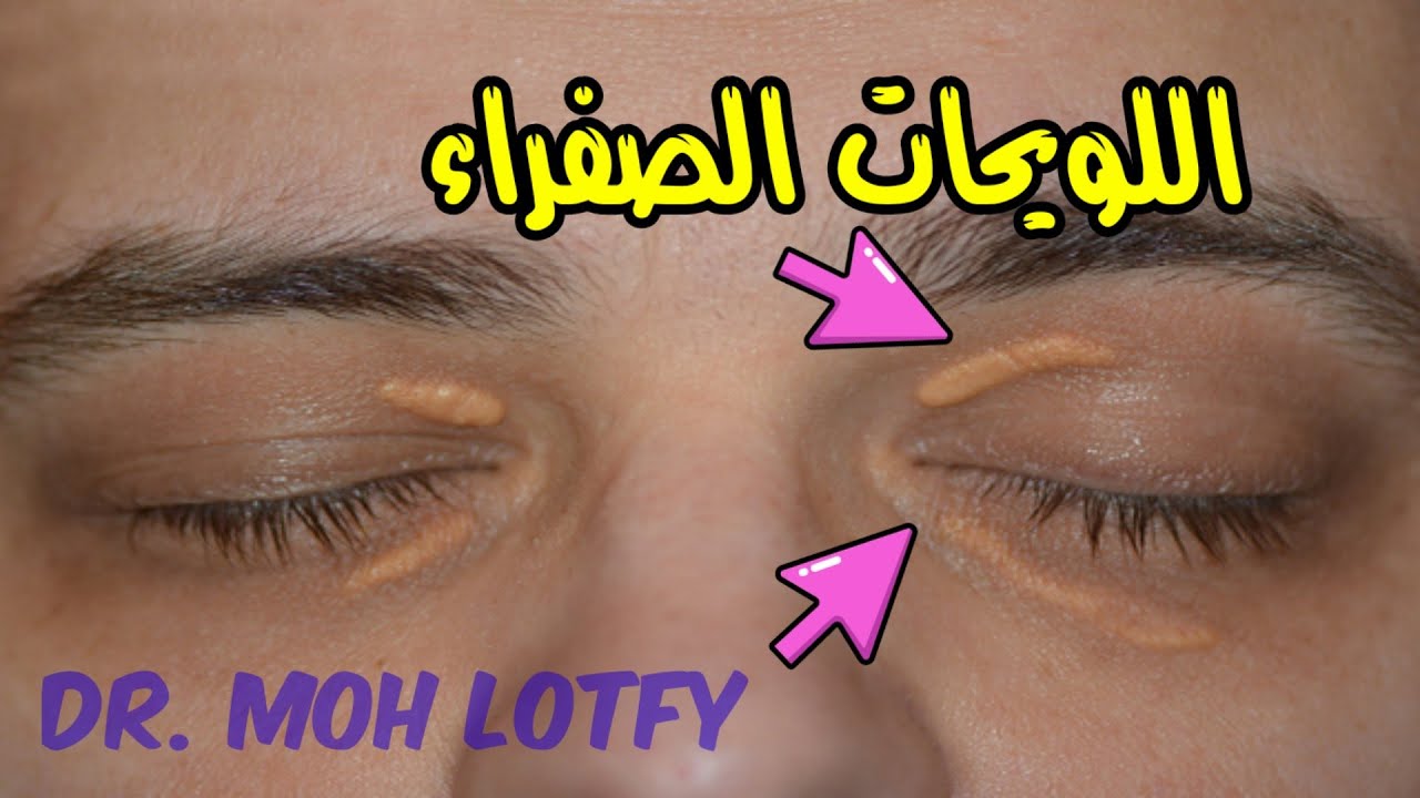 الاكياس الدهنية الصفراء حول جفن العين,,اللويحات الصفراء في العين,اللويحات الصفراء حول العين