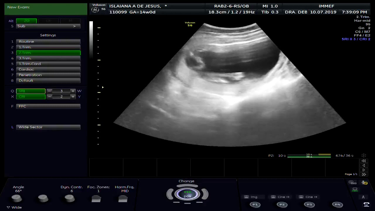 14 semanas - descobrindo a Melissa pelo Ultrassom Obstétrica!