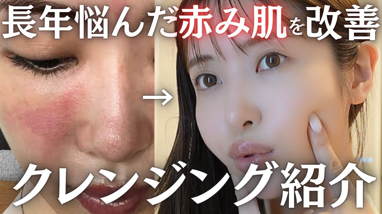赤みで悩んだ肌を改善！私を救ったクレンジング紹介します✨